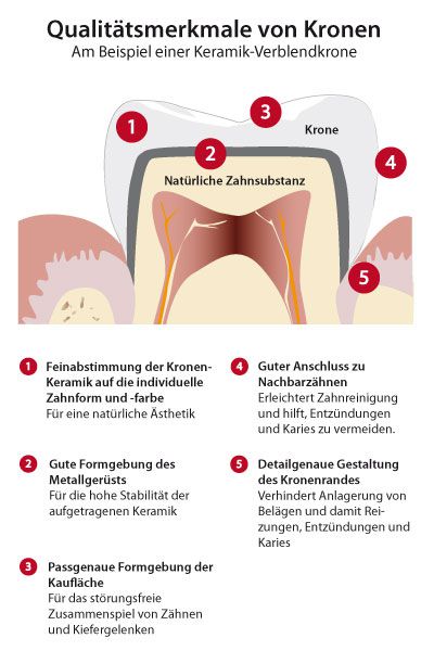 Qualitätsmerkmale Kronen